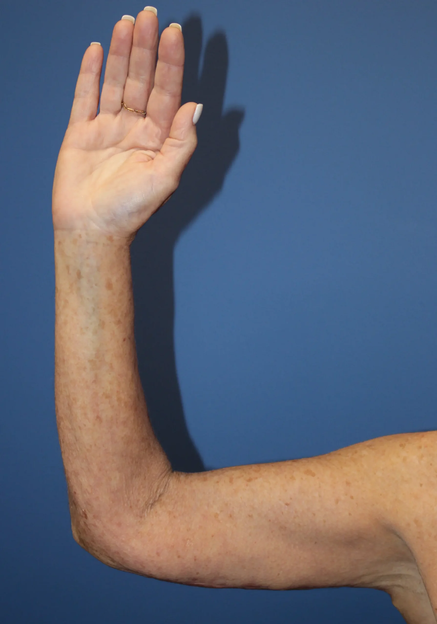 ArmliftAfter_SurekPlasticSurgery