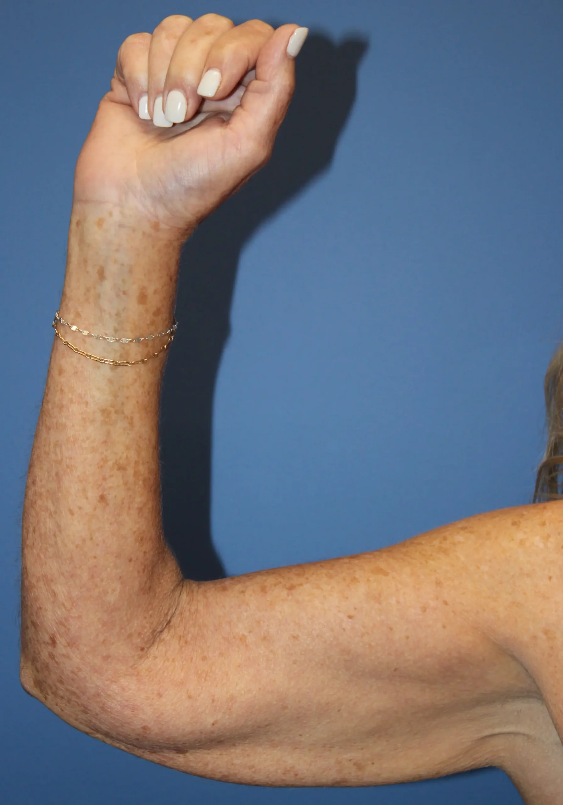 ArmliftBefore_SurekPlasticSurgery