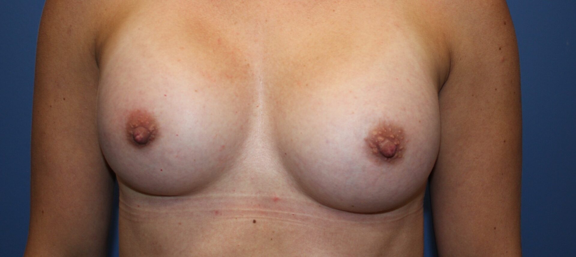 BreastAugAfter3_SurekPlasticSurgery-e1768327022986