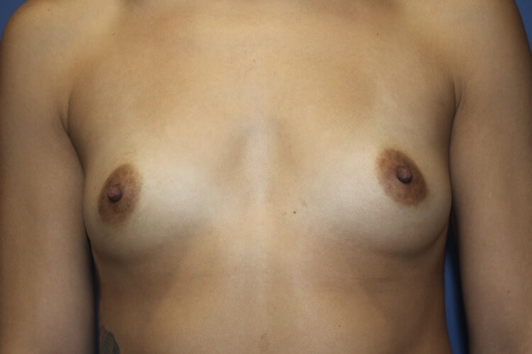 BreastAugBefore1_SurekPlasticSurgery