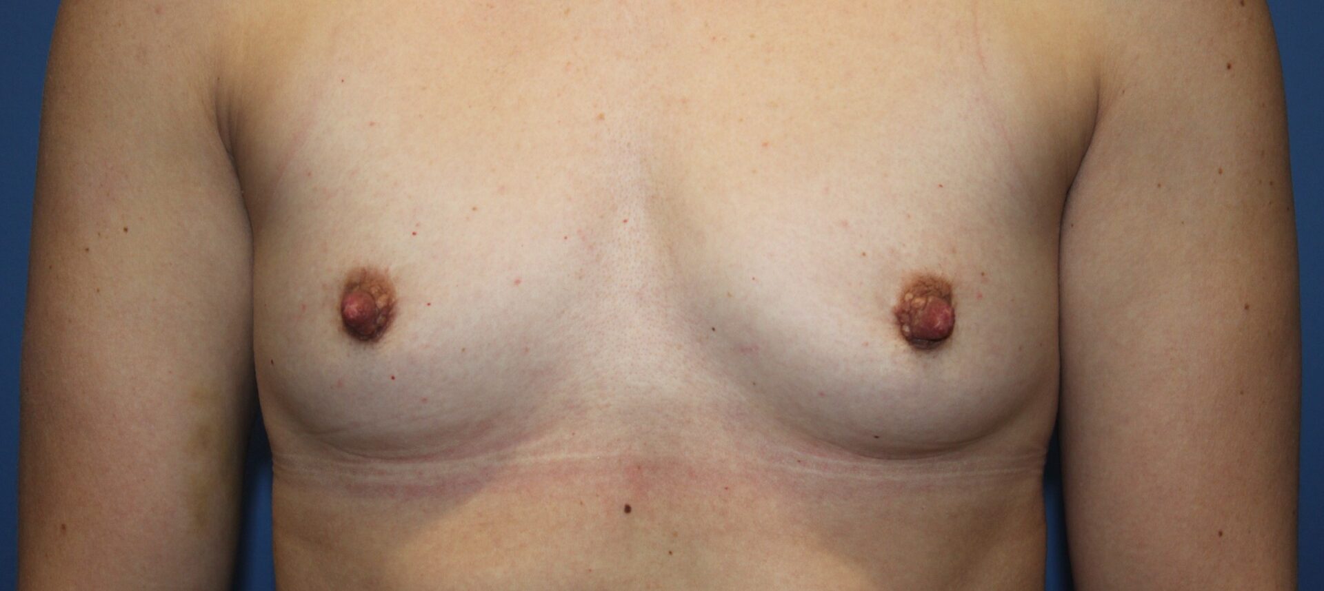 BreastAugBefore3_SurekPlasticSurgery-e1768326945493