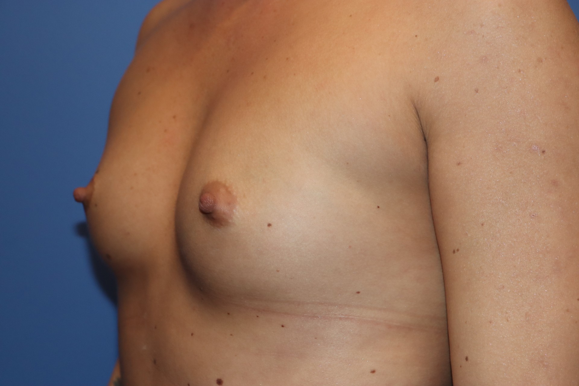 BreastAugBefore5_SurekPlasticSurgery