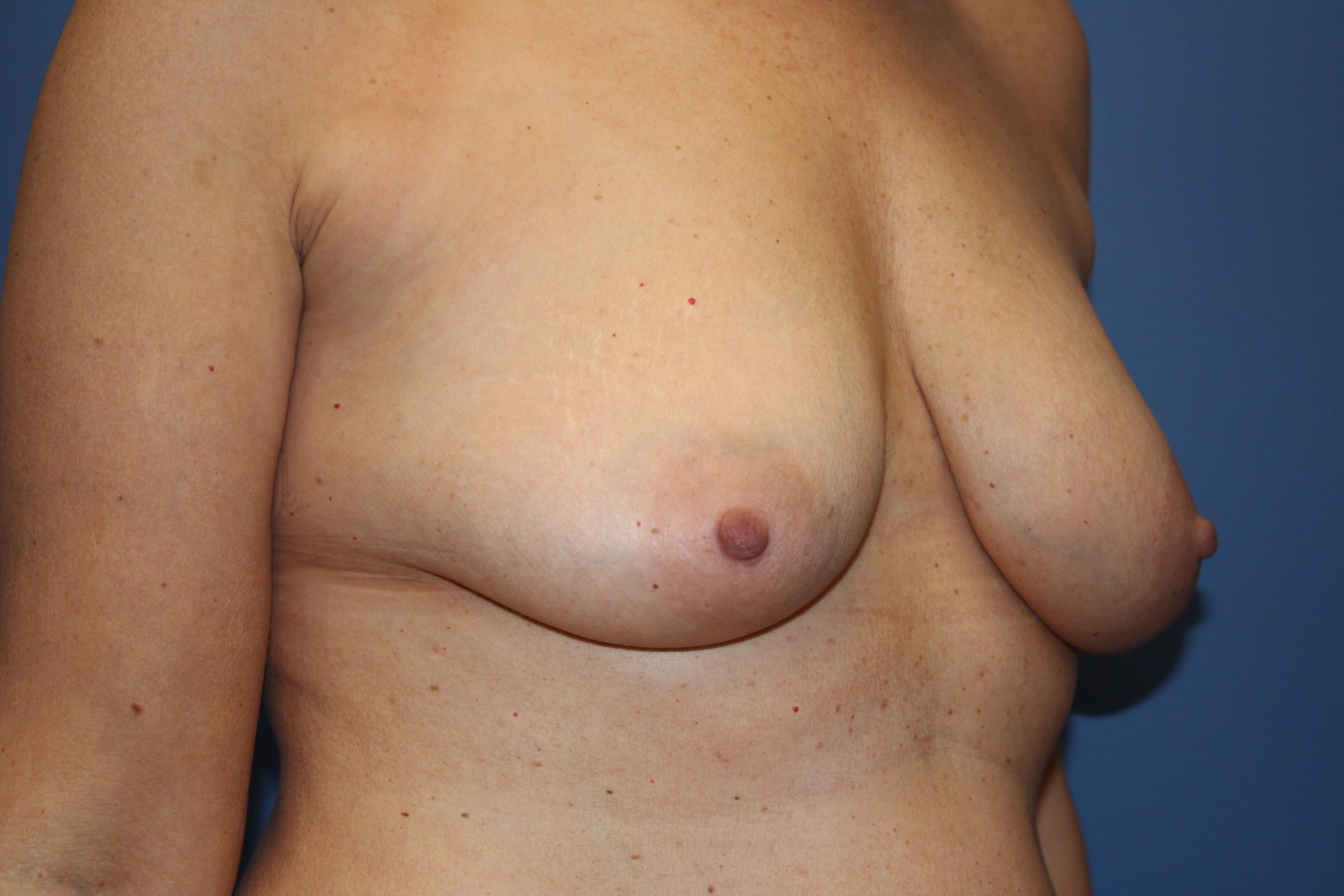 BreastAugBefore8_SurekPlasticSurgery