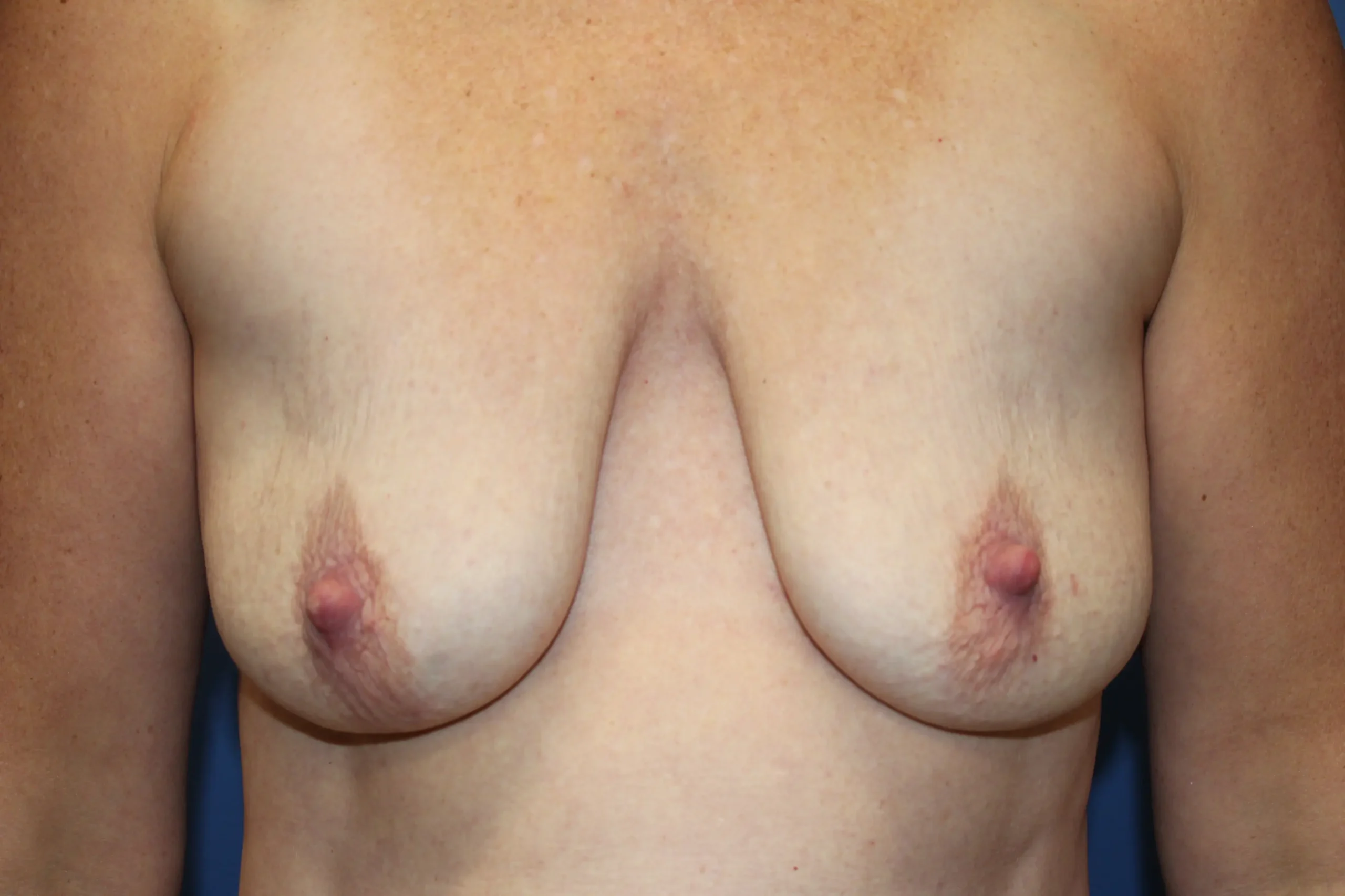 BreastAugLiftBefore1_SurekPlasticSurgery