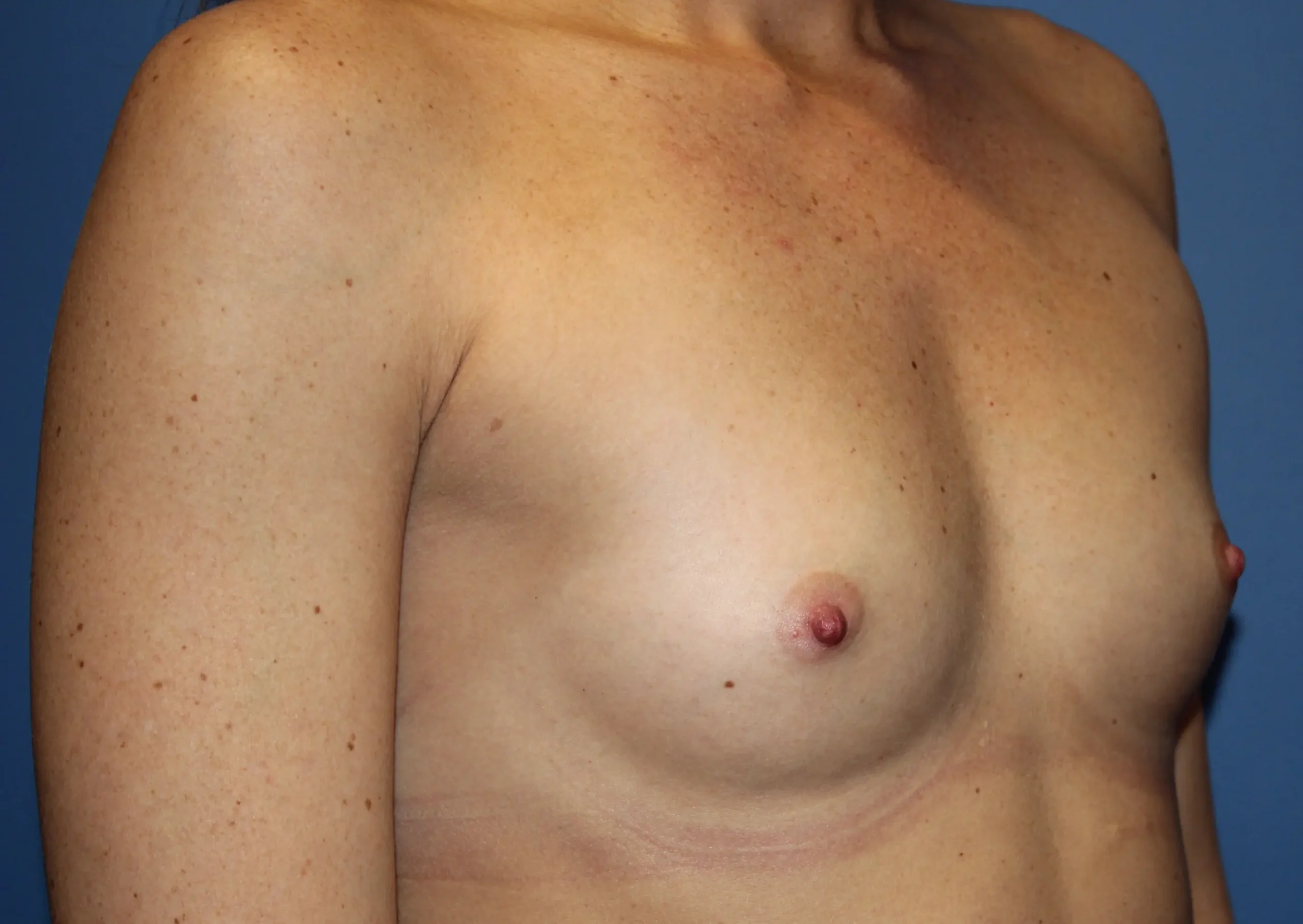 BreastAugmentationBefore_SurekPlasticSurgery