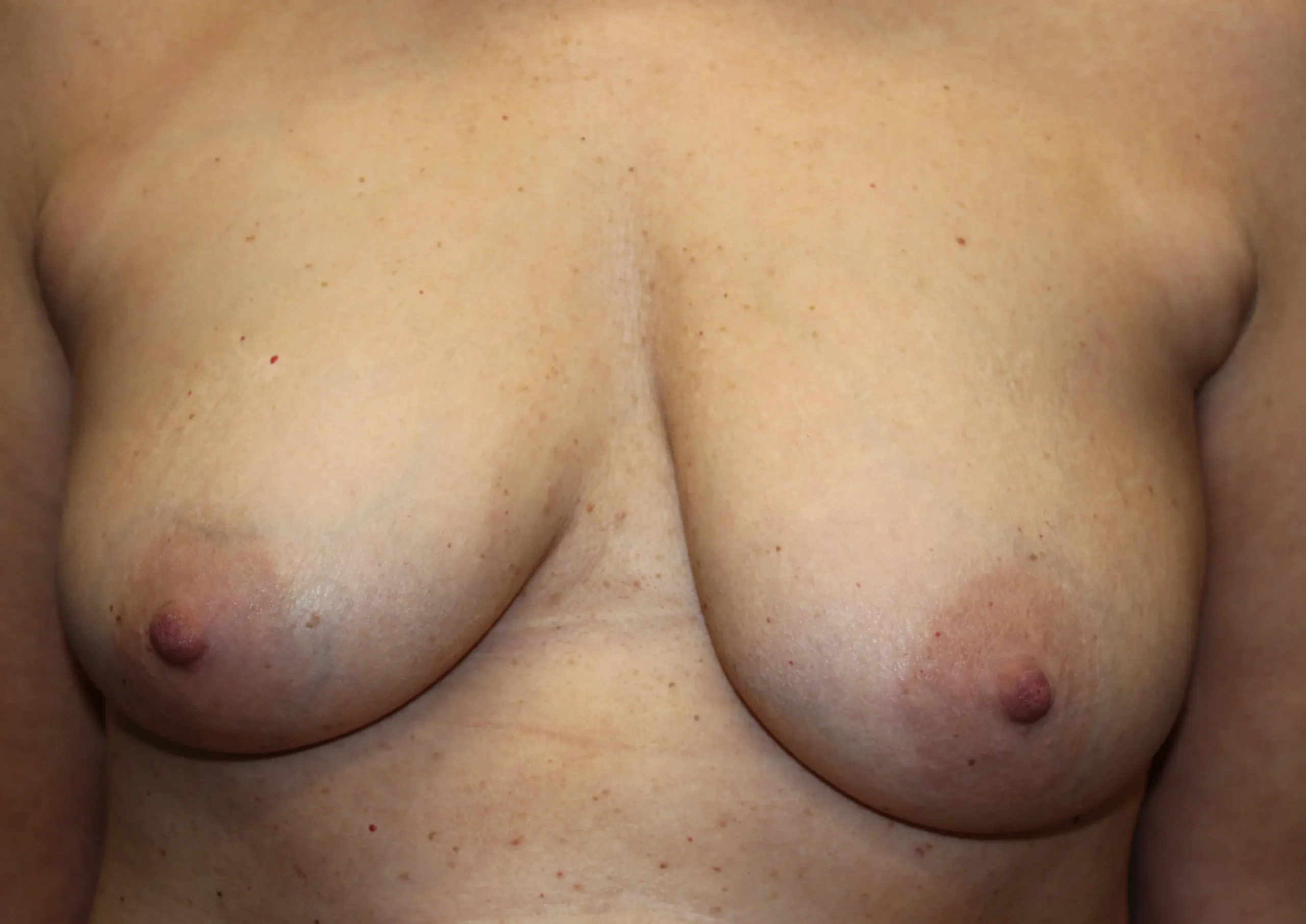 BreastAugmentationLift_SurekPlasticSurgery