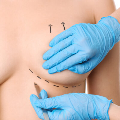 Woman and doctor with lancet on white background, closeup. Concept of breast augmentation