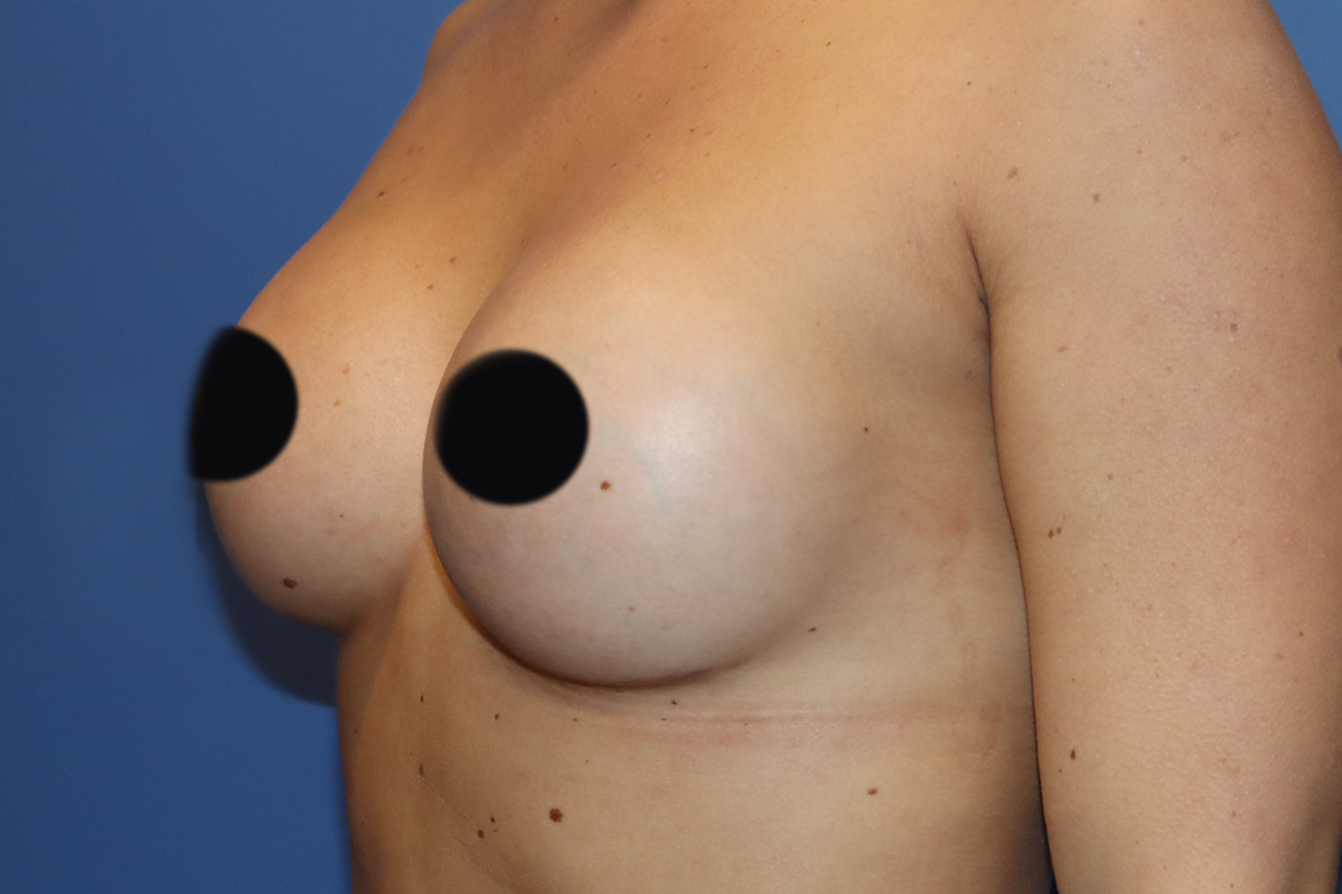 Breast_AfterPhoto_MDaab_Aligned.jpg