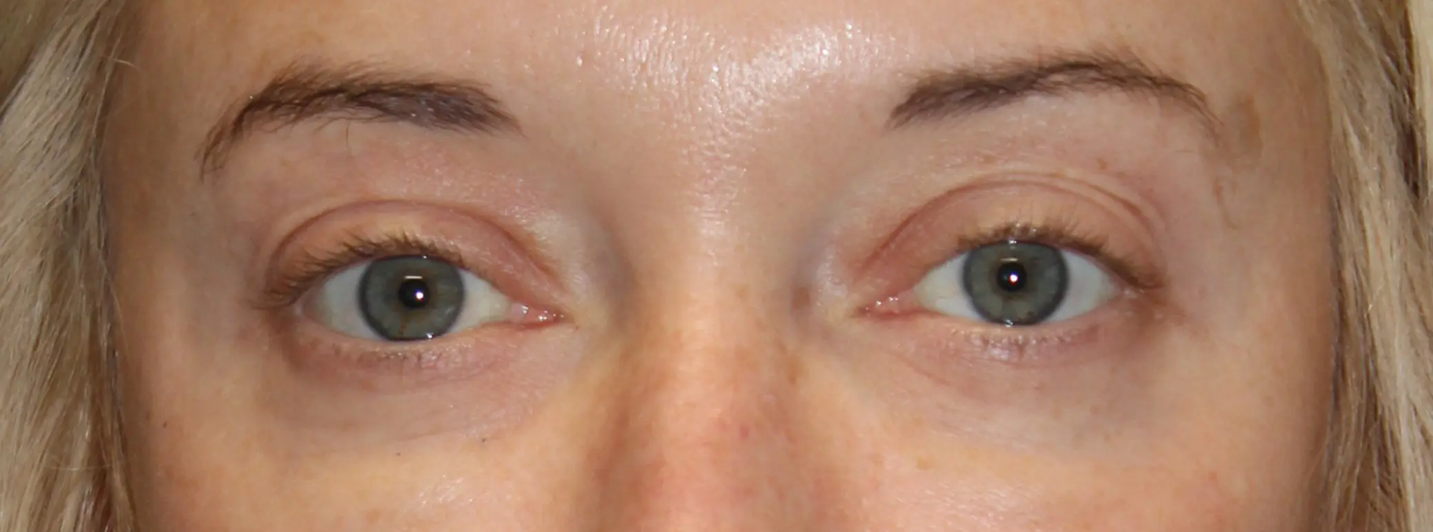 EyelidsAfter_SurekPlasticSurgery