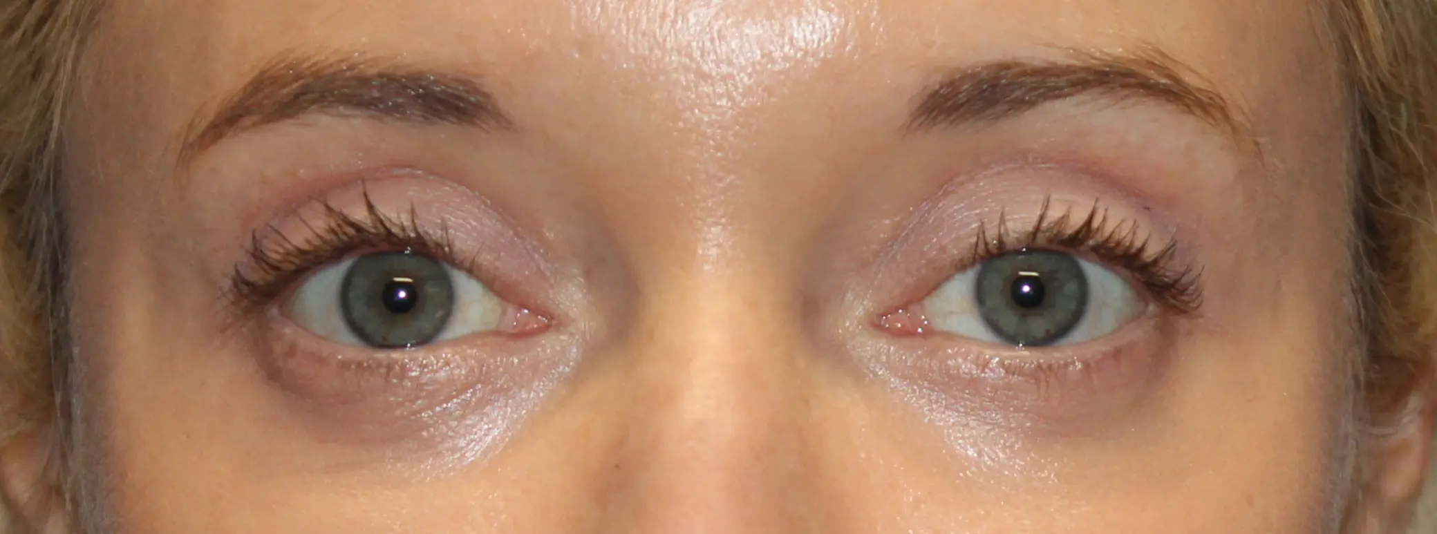 EyelidsBefore_SurekPlasticSurgery