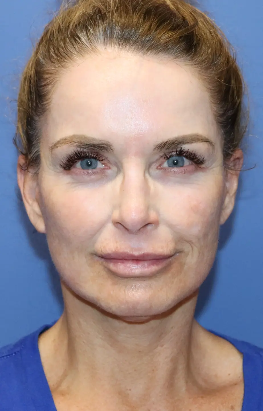 FaceliftNeckliftEyelidsAfter_SurekPlasticSurgery