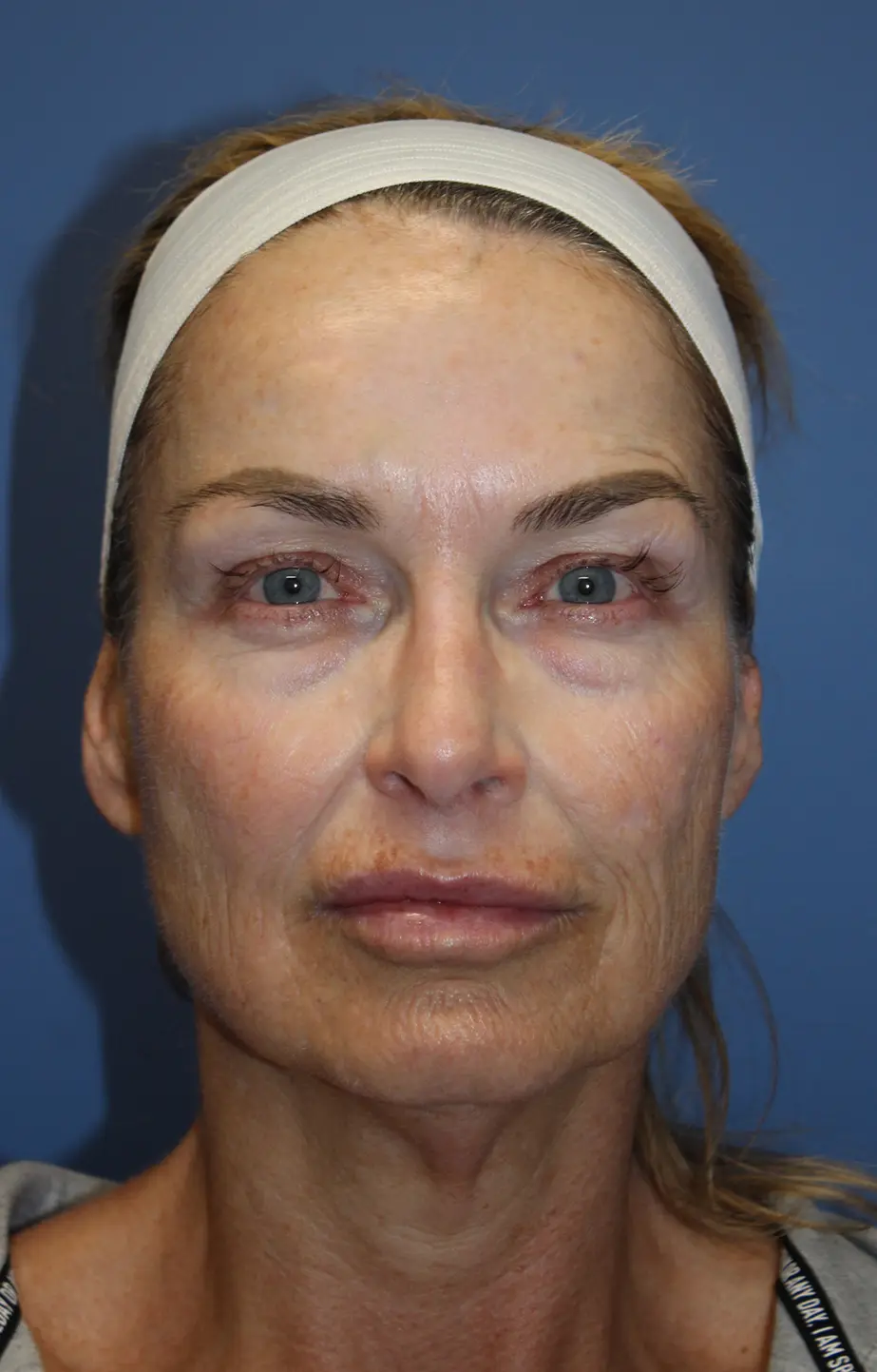 FaceliftNeckliftEyelidsBefore_SurekPlasticSurgery