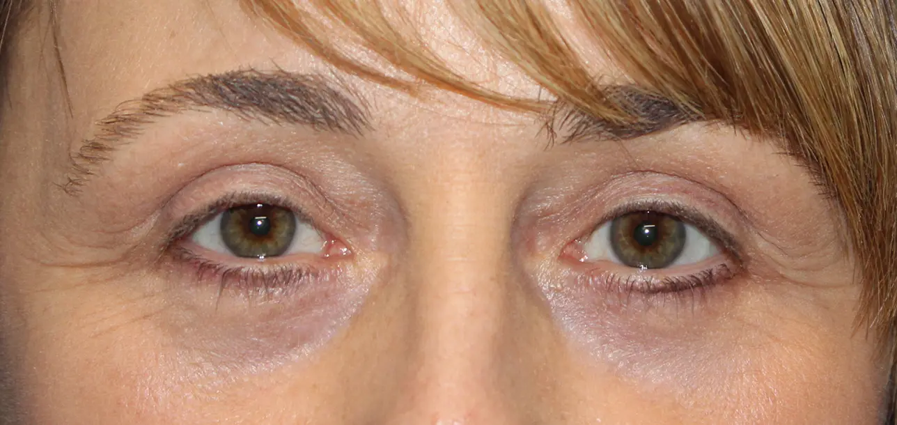 FemaleEyelidAfter_SurekPlasticSurgery