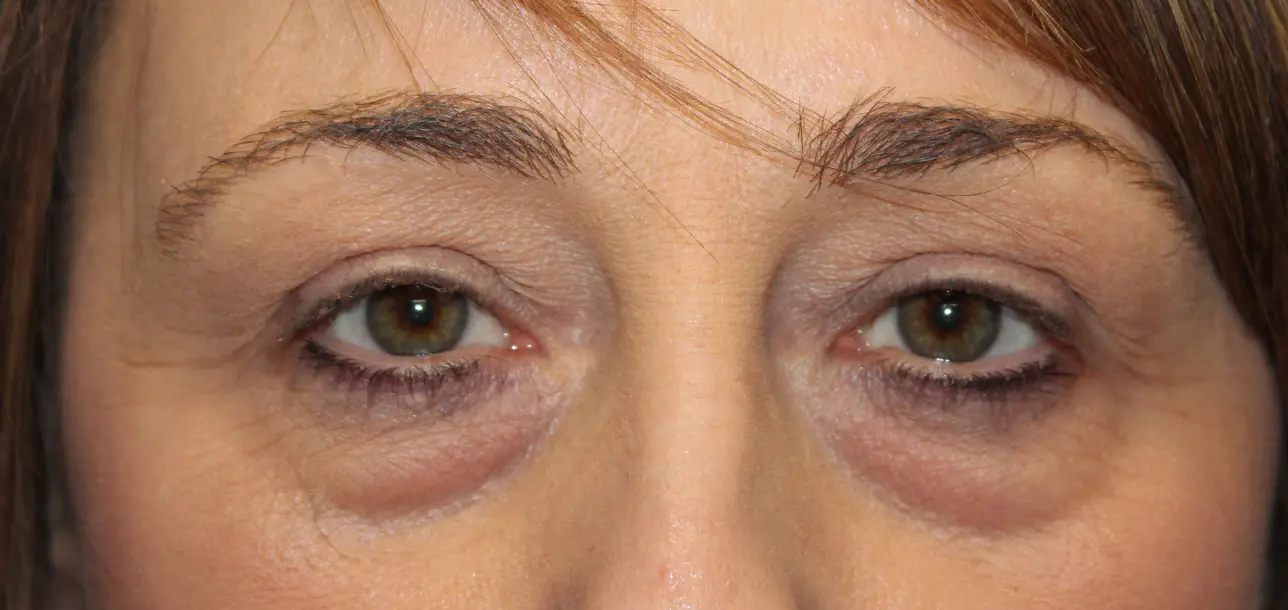 FemaleEyelidBefore_SurekPlasticSurgery