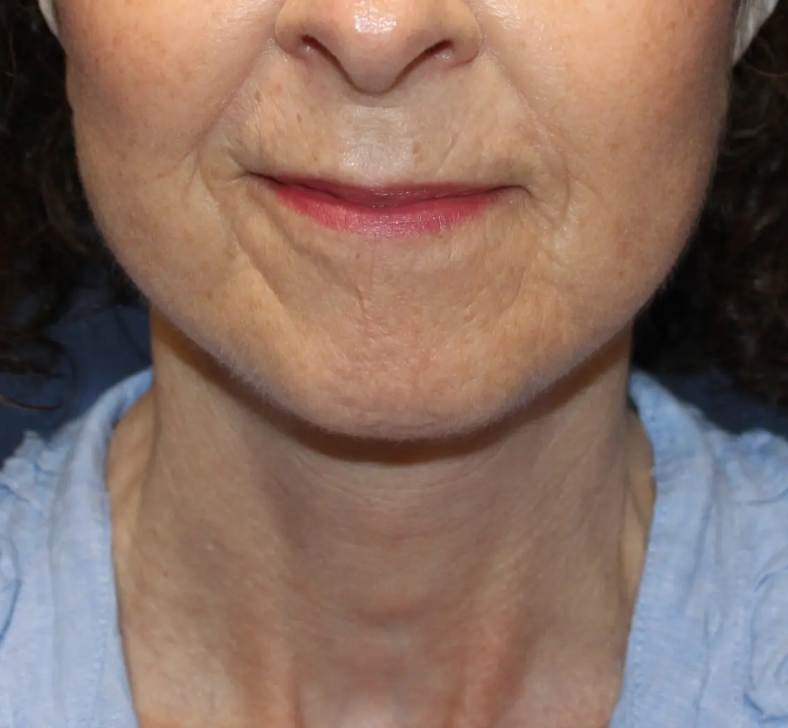 LowerFaceliftNeckliftAfter1_SurekPlasticSurgery
