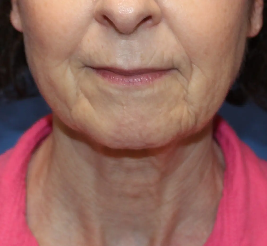 LowerFaceliftNeckliftBefore1_SurekPlasticSurgery