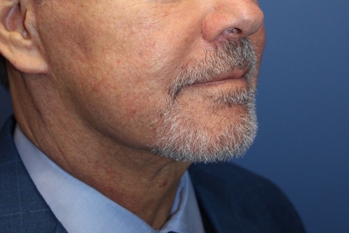 MaleExtendedNeckliftAfter_SurekPlasticSurgery