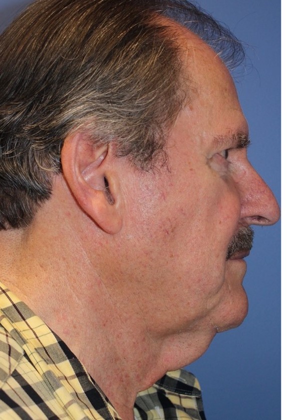 MaleExtendedNeckliftBefore1_SurekPlasticSurgery