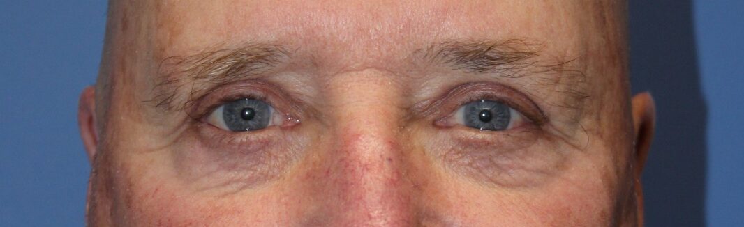 MaleEyelidAfter1_SurekPlasticSurgery-e1764959134452