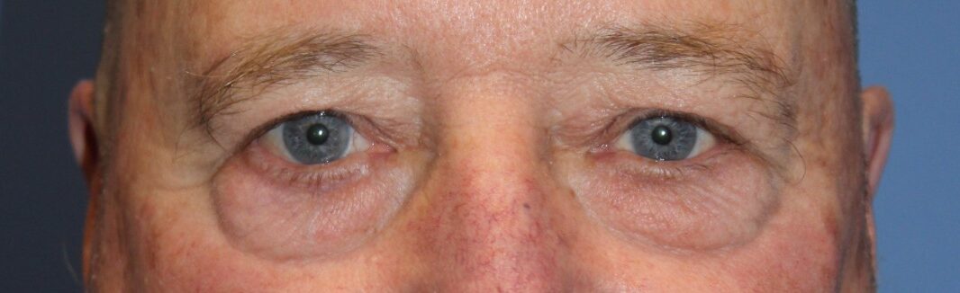 MaleEyelidBefore1_SurekPlasticSurgery-e1764958994881