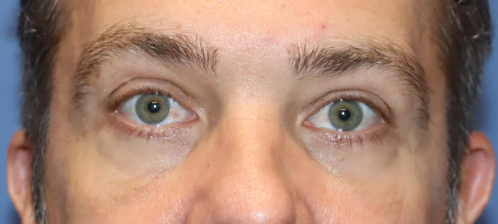 MaleEyelidsAfter_SurekPlasticSurgery