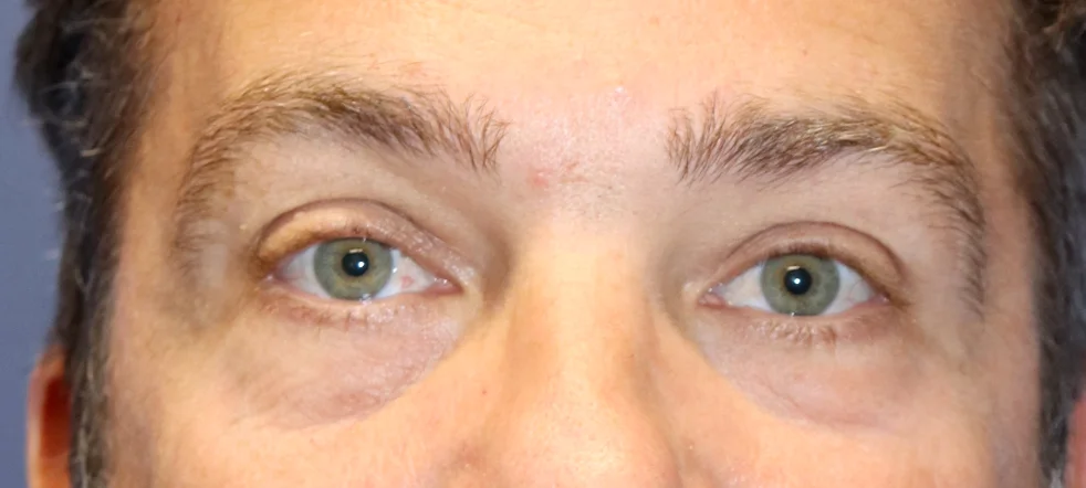 MaleEyelidsBefore_SurekPlasticSurgery-e1766179383346