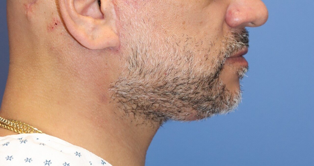 MaleNeckliftAfter_SurekPlasticSurgery-e1767732665544