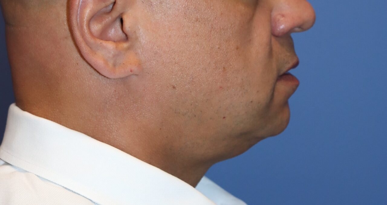 MaleNeckliftBefore_SurekPlasticSurgery-e1767732608158