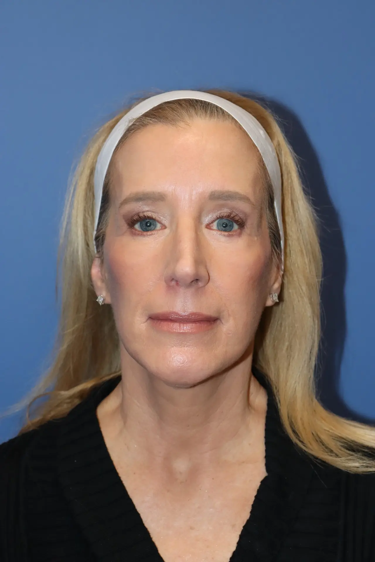 NewFaceliftAfter3_SurekPlasticSurgery