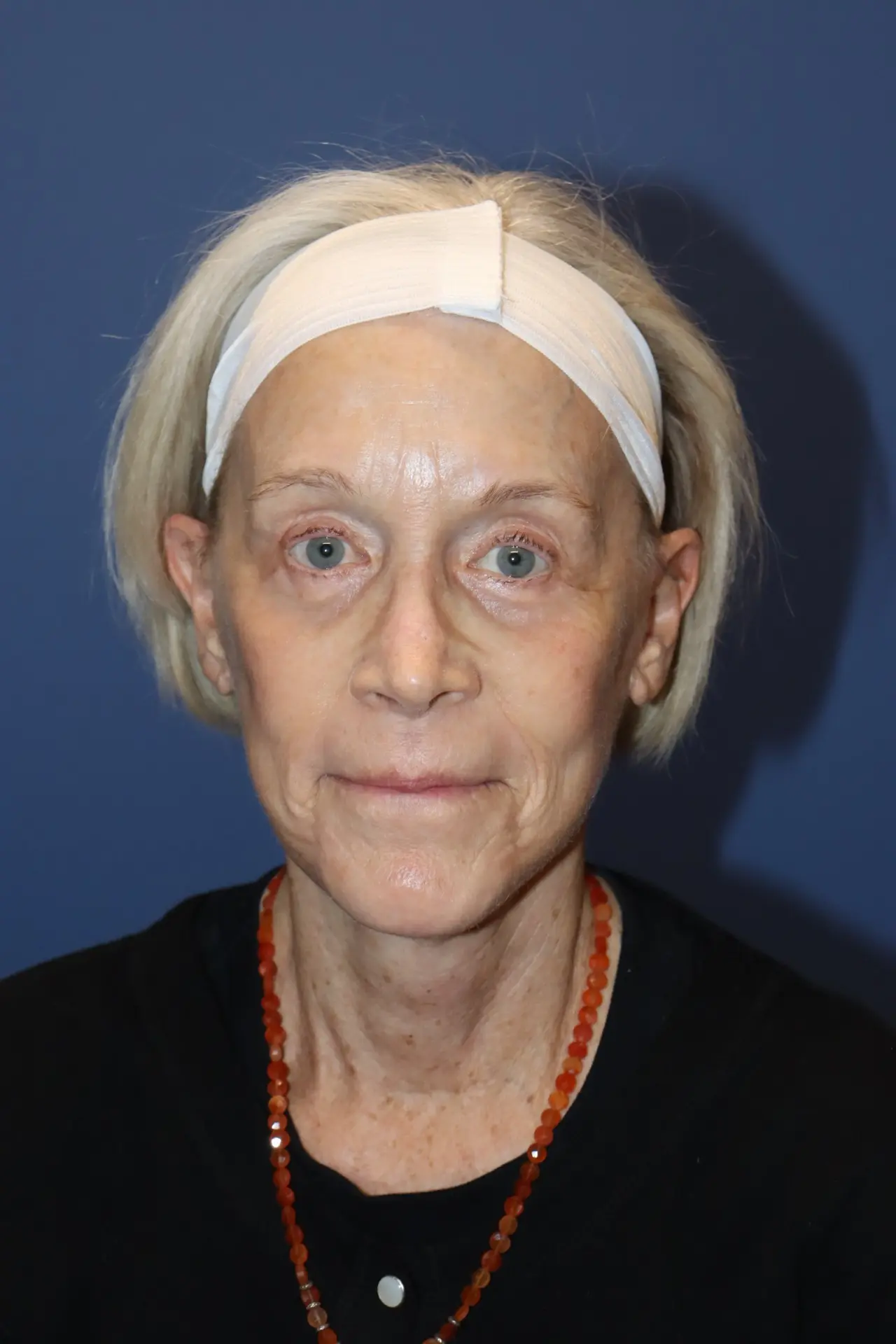 NewFaceliftAfter4_SurekPlasticSurgery