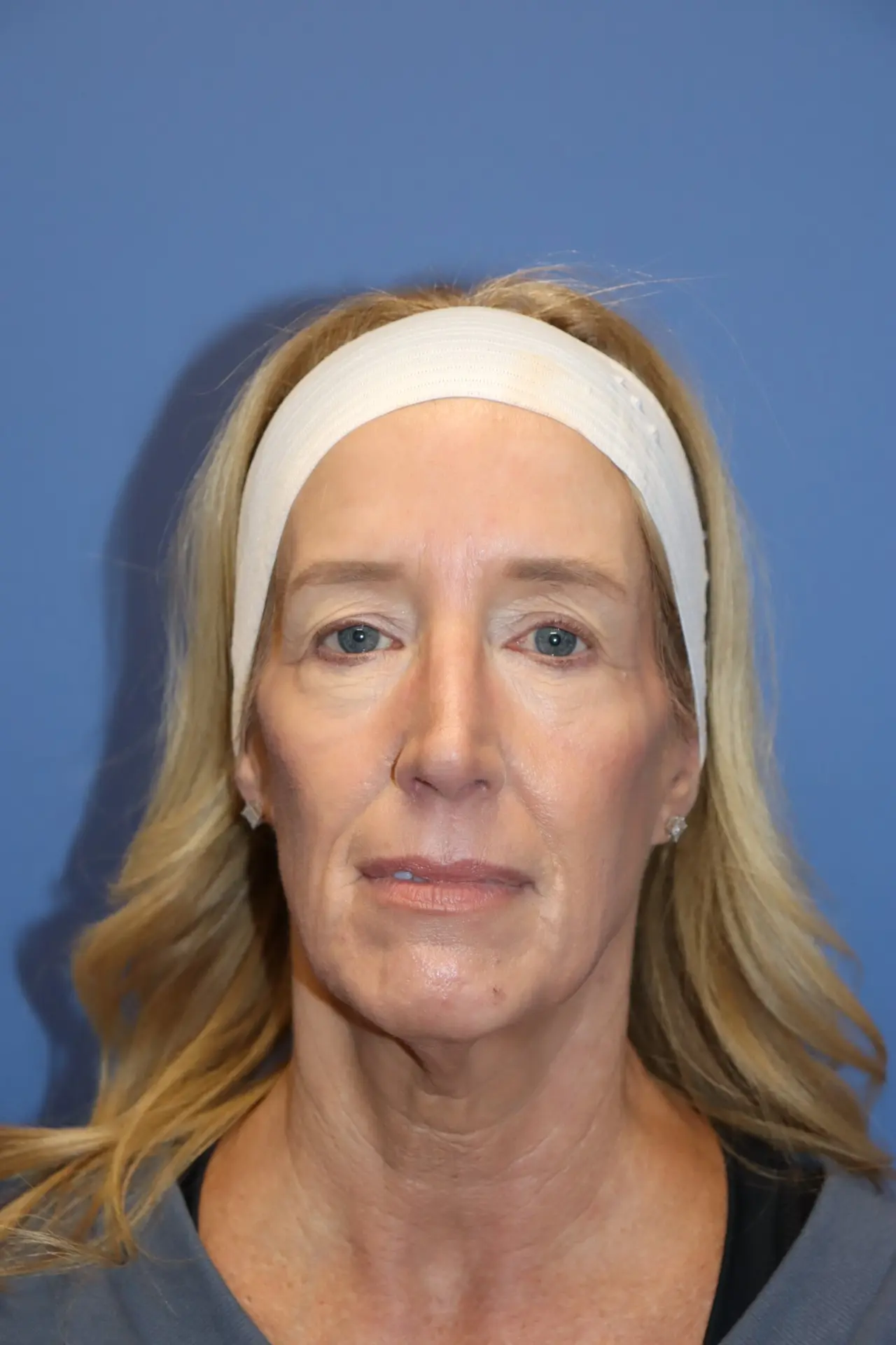 NewFaceliftBefore3_SurekPlasticSurgery