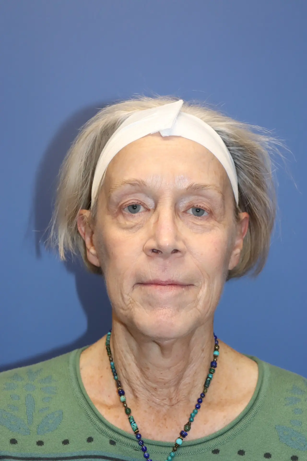 NewFaceliftBefore4_SurekPlasticSurgery