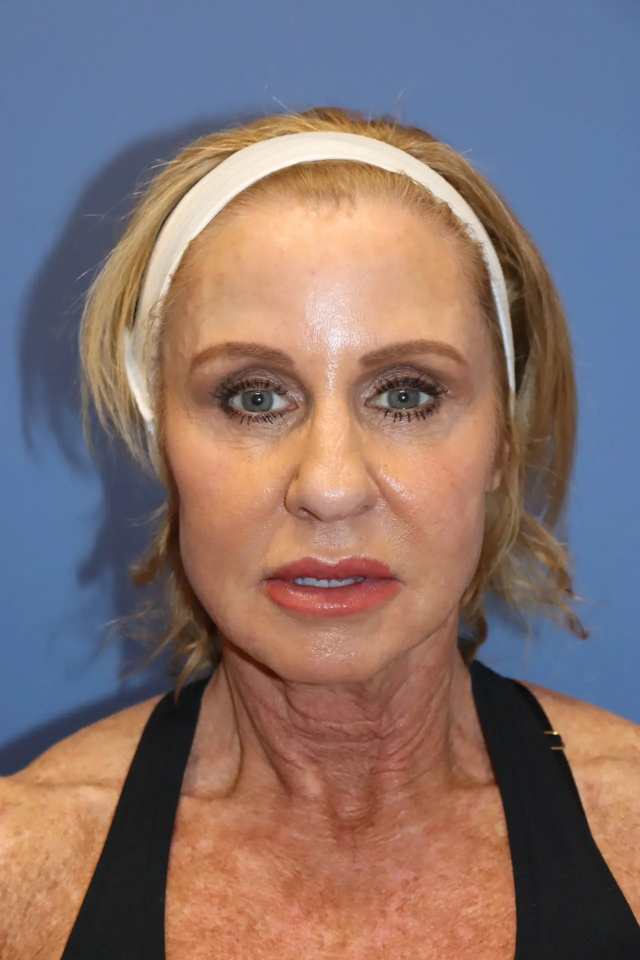 NewLowerFacelift8_SurekPlasticSurgery