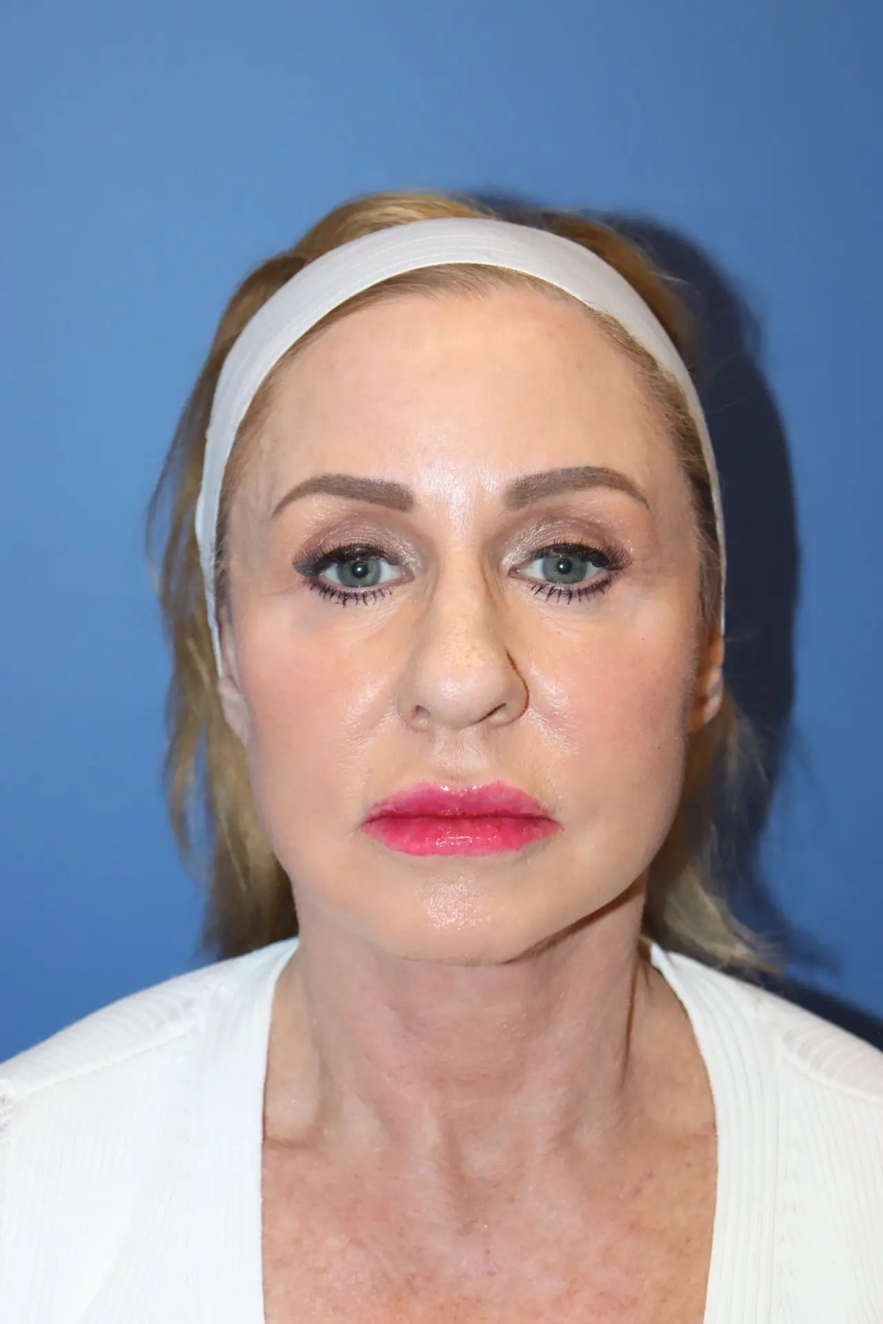 NewLowerFaceliftAfter8_SurekPlasticSurgery