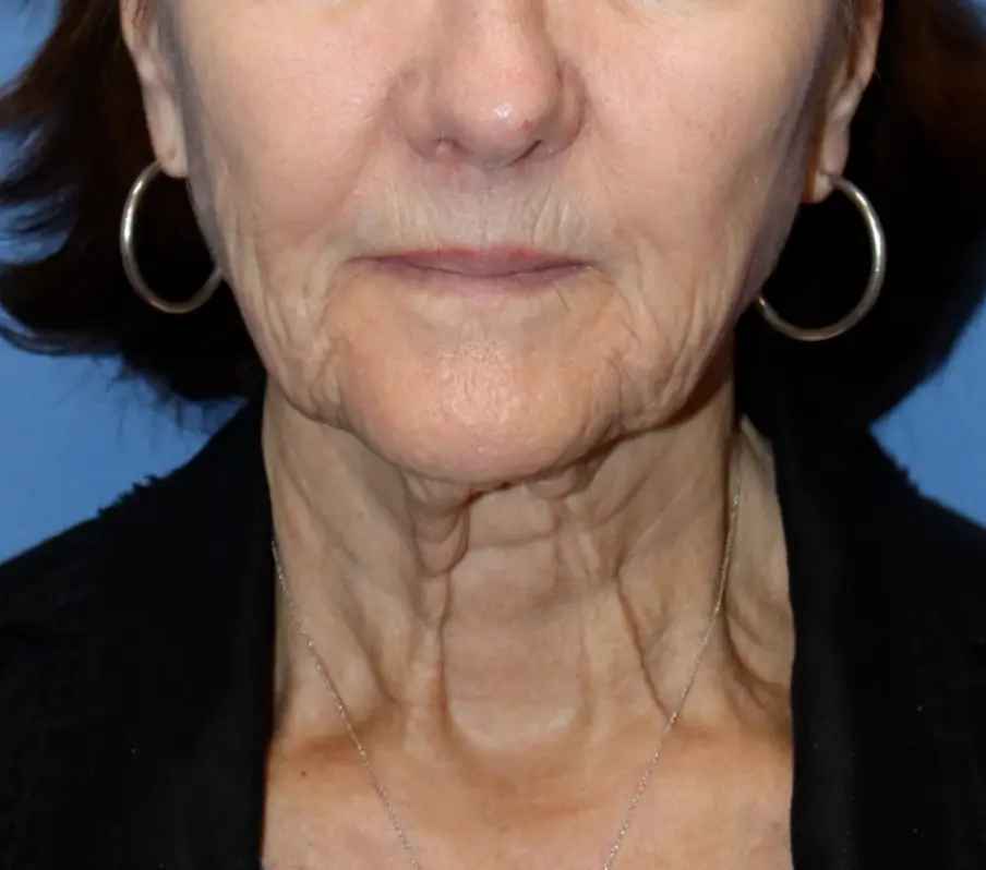 NewSurekLowerFace1_Before-e1766176385548