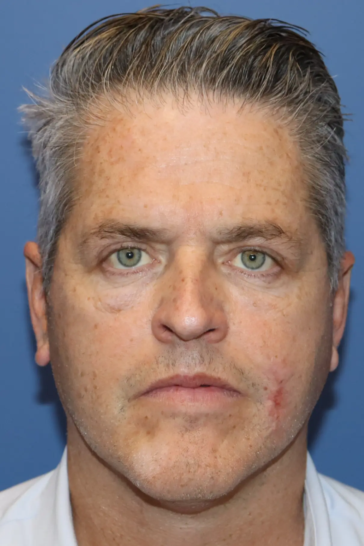 NewSurekLowerFaceMale_After