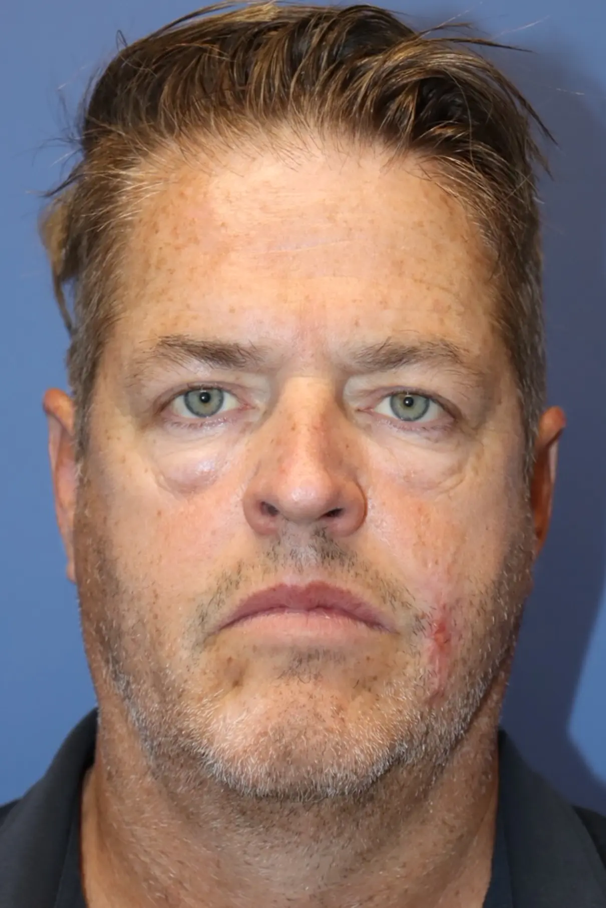 NewSurekLowerFaceMale_Before