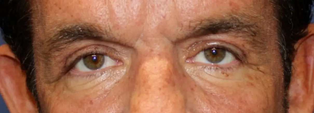 NewSurekMaleEyelid_After-e1766180623381