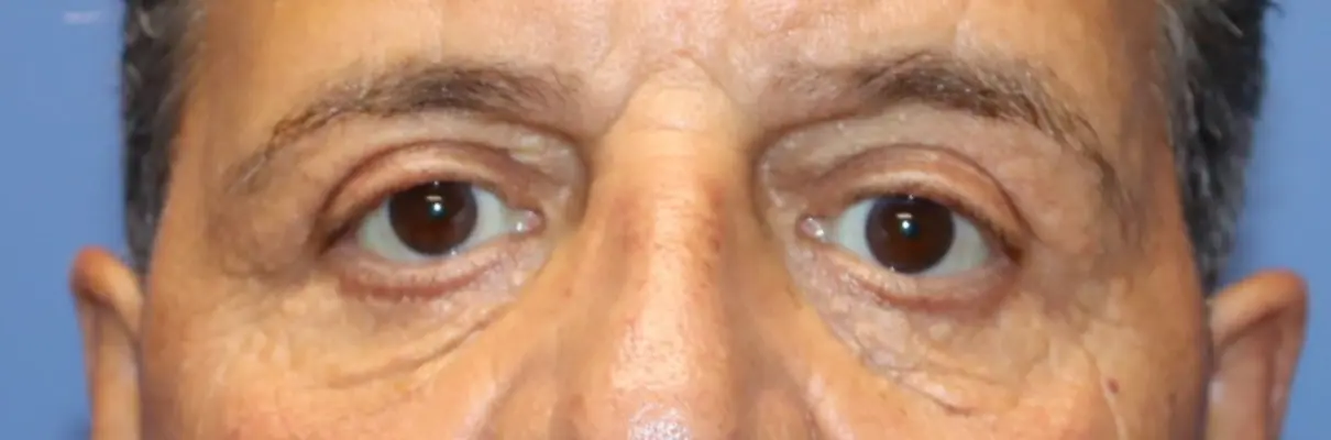 NewSurekMaleEyelid_After1-e1767629800377