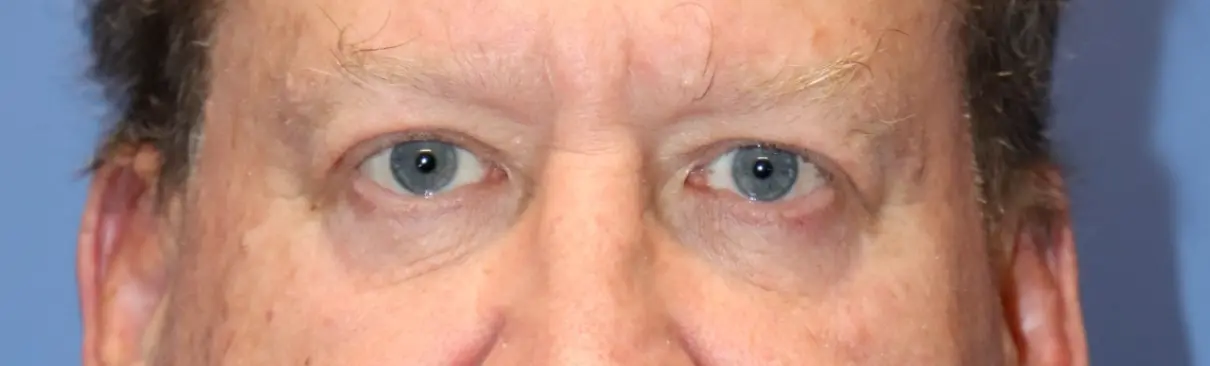 NewSurekMaleEyelid_After2-e1767635308412