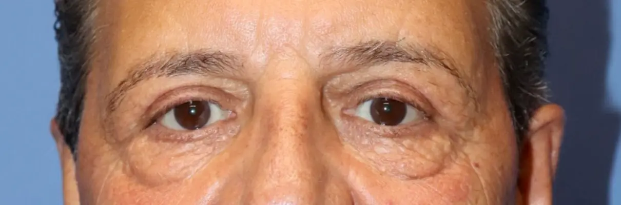 NewSurekMaleEyelid_Before1-e1767629775897