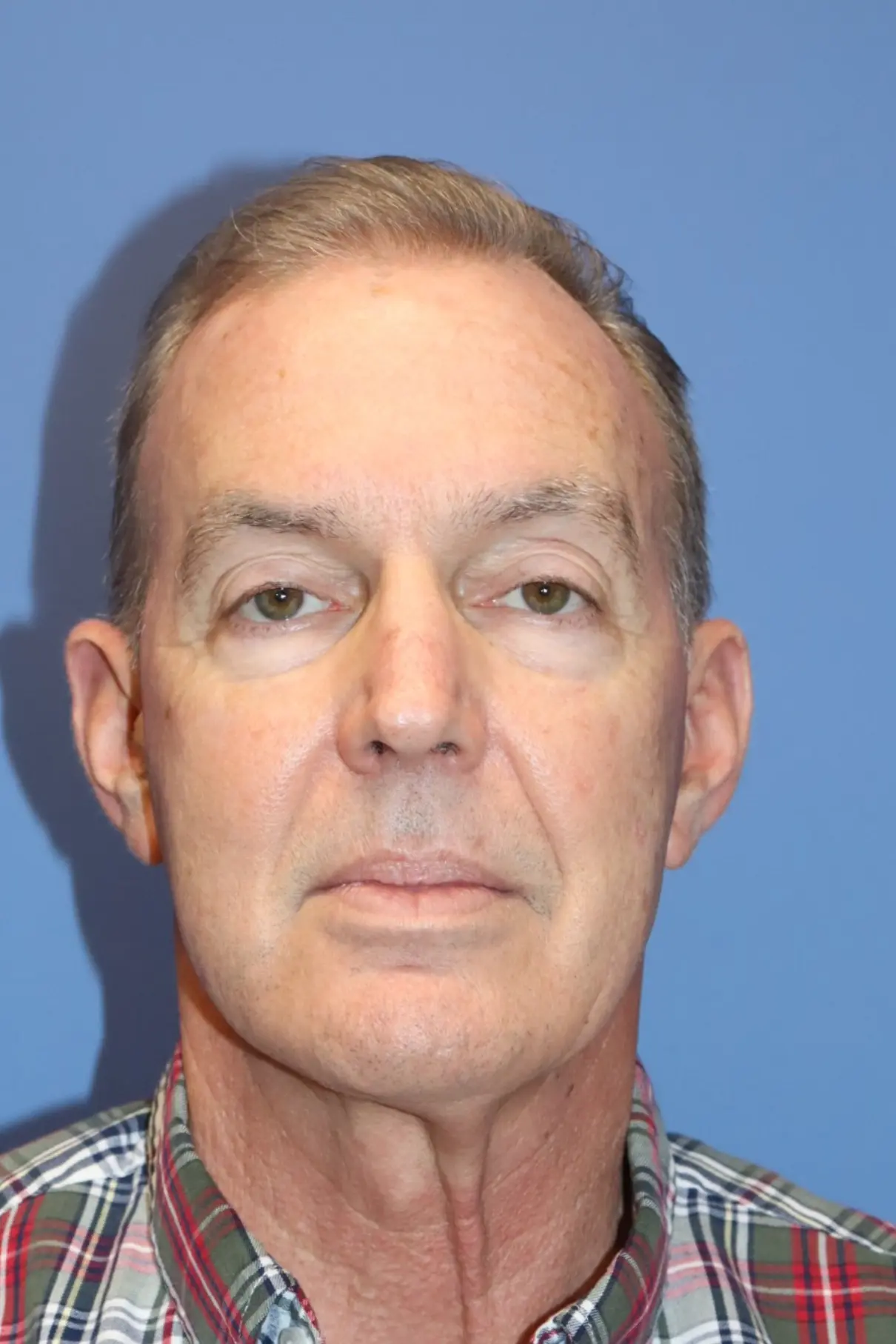 NewSurekMaleEyelid_Before3