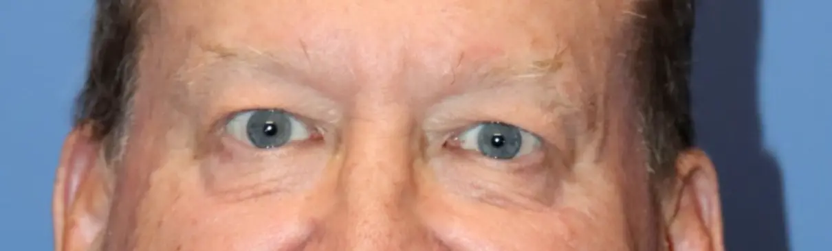 NewSurekMaleEyelids_Before2-e1767635276952