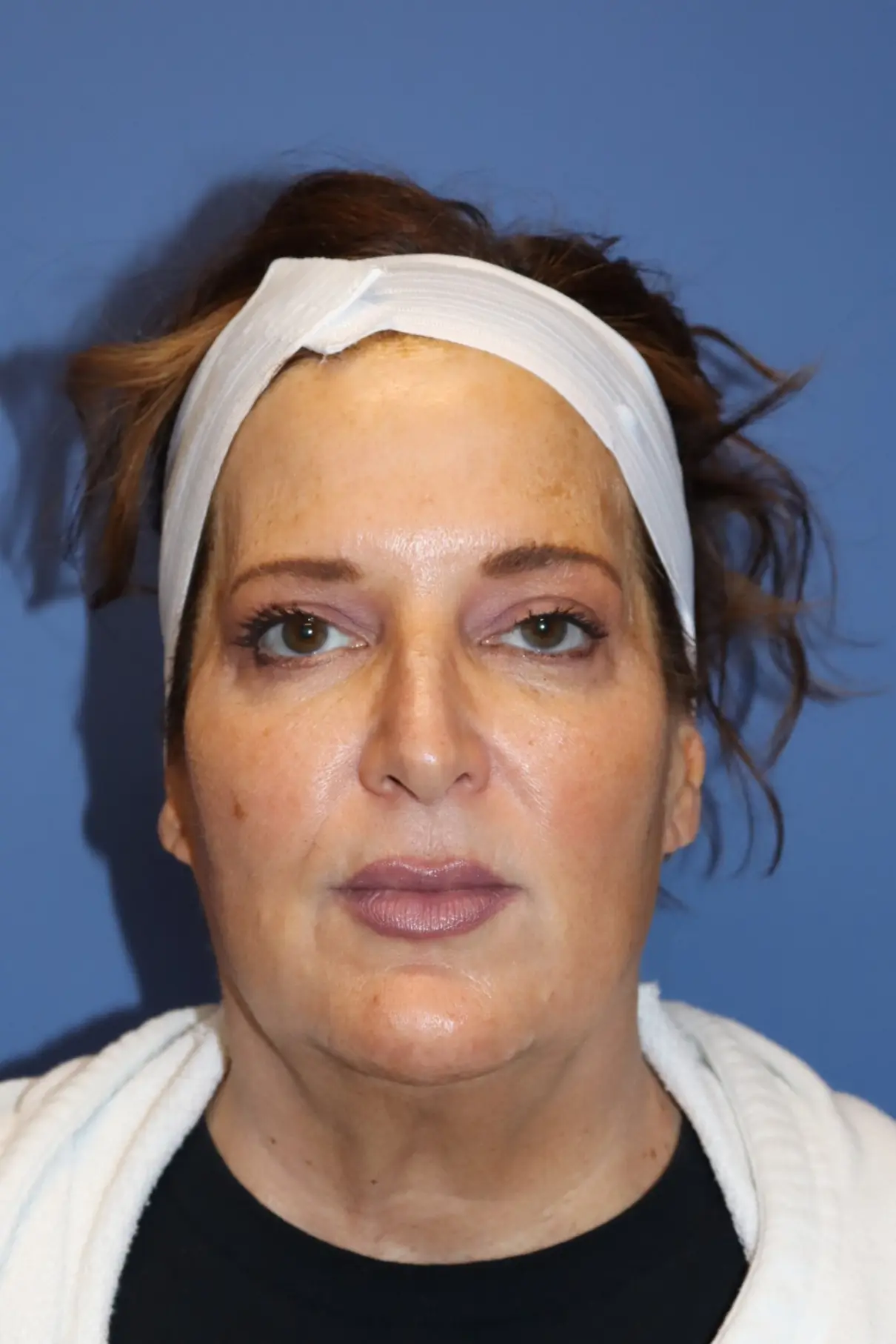 NewSurekNecklift_Before