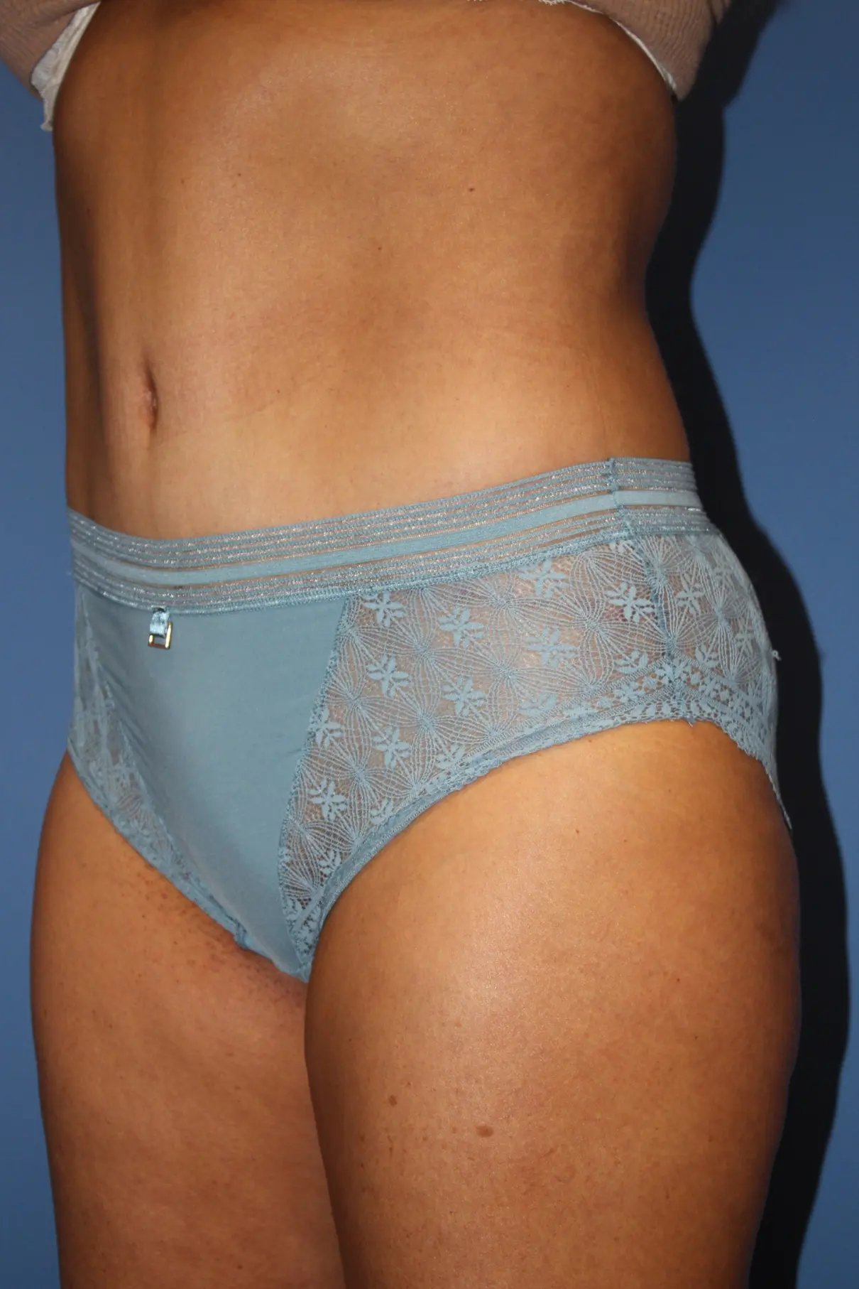 NewSurekTummyTuck_After