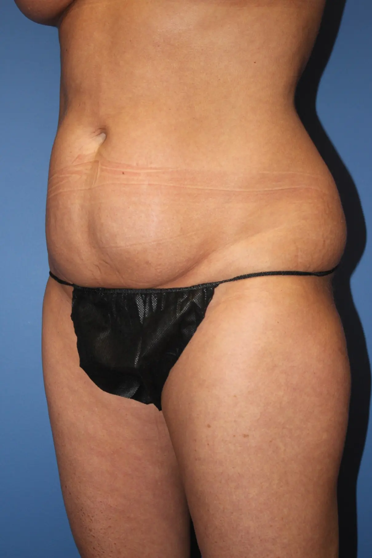 NewSurekTummyTuck_Before