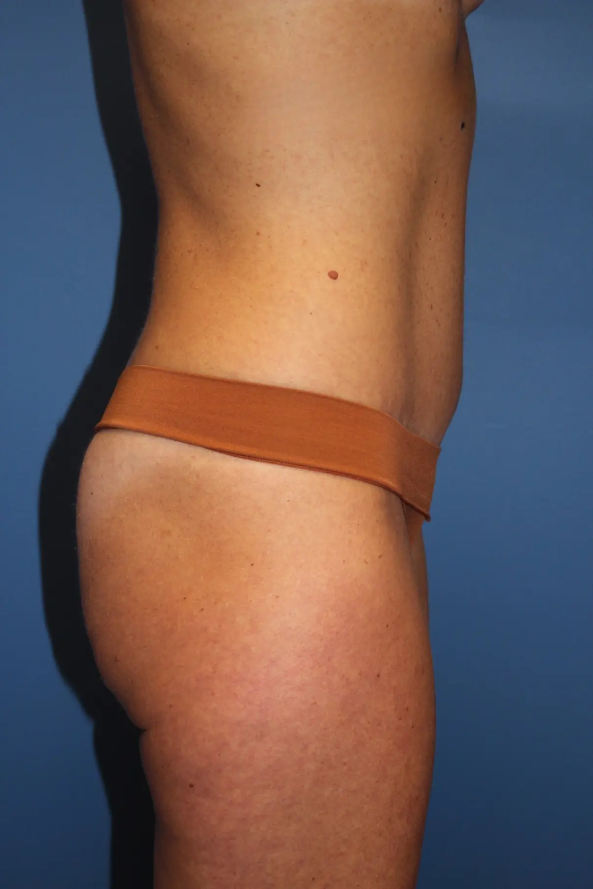 NewTummyTuckAfter6_SurekPlasticSurgery