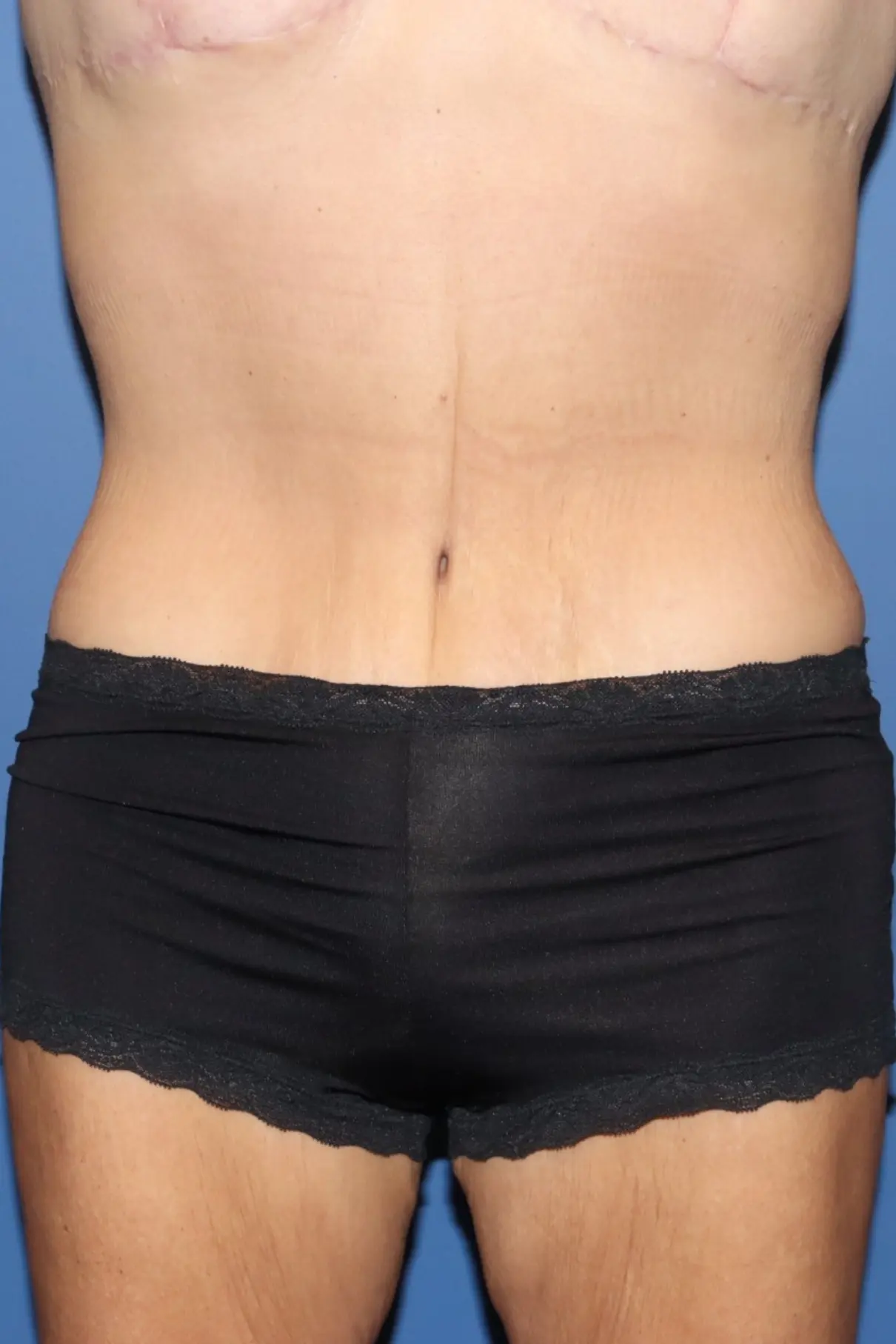 Surek-Before-After-Pictures-1