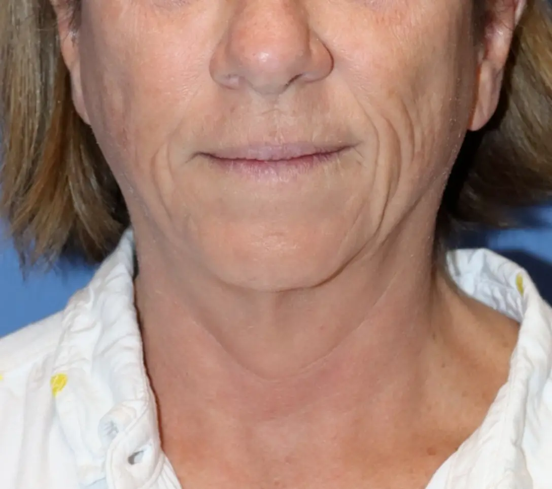 Surek-Before-After-Pictures-e1766168924611