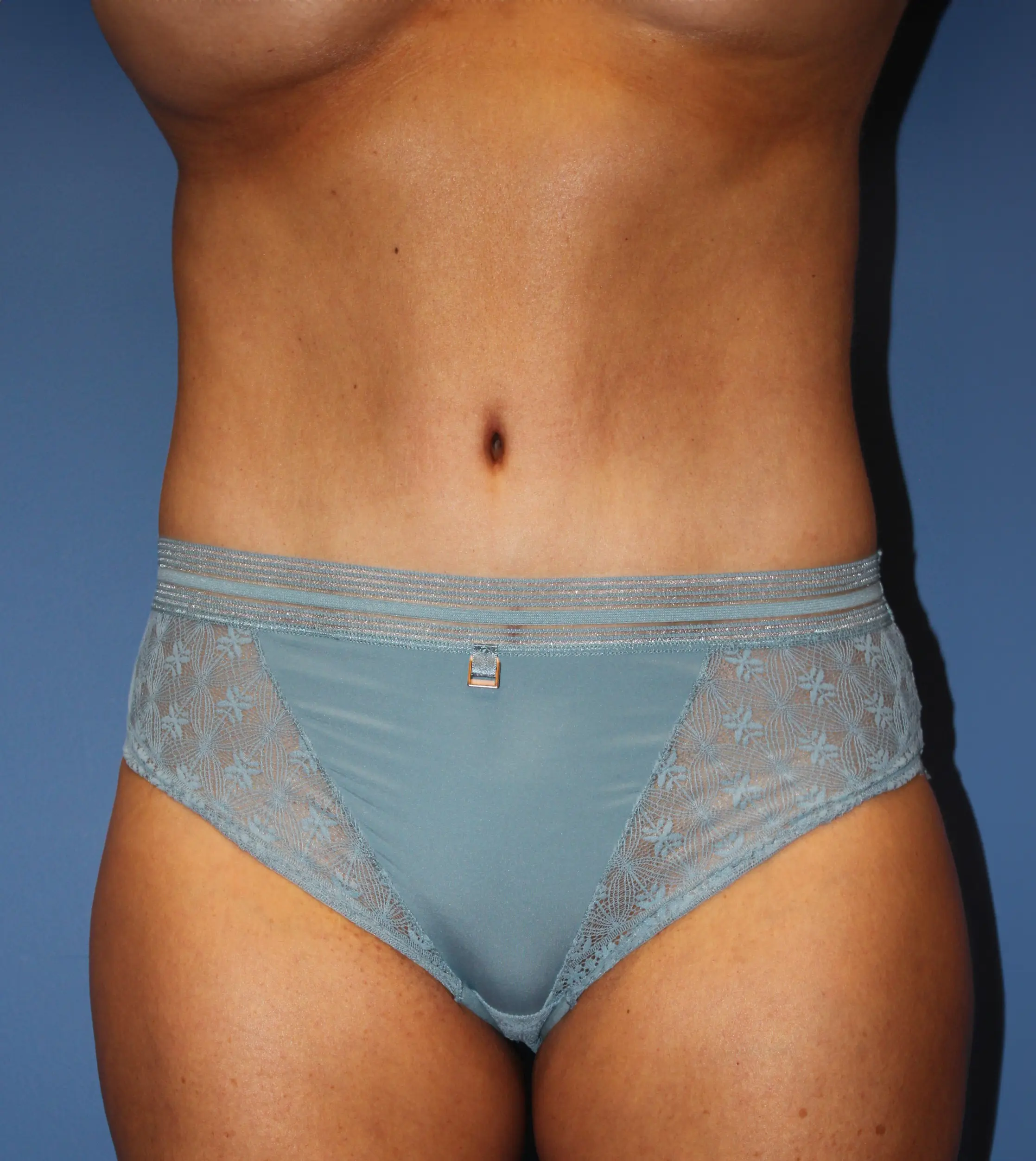 TummyTuck360LipoAfter_SurekPlasticSurgery